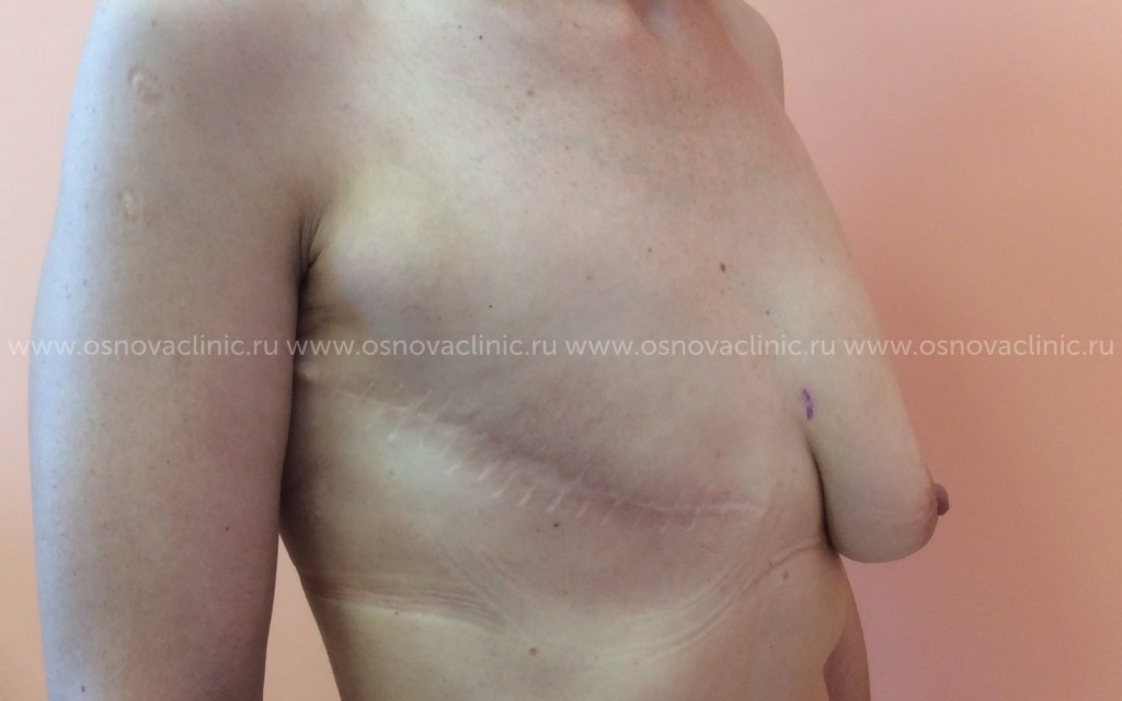 Клиника Основа. Доктор Тимошенко. Увеличение груди при мастэктомии. Установка эспандера. Фото до операции. Вид сбоку.