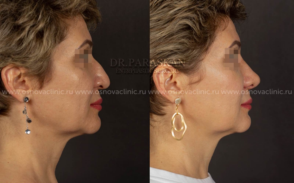 Клиника Основа Параскан Исправление свисающего кончика носа, удаление горбинки