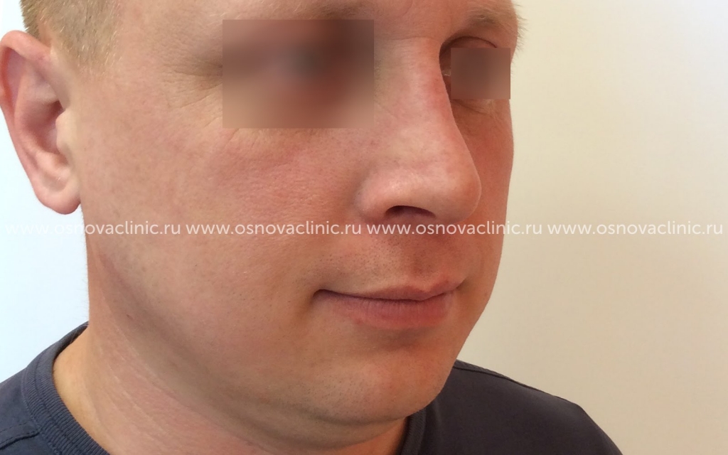 Клиника Основа Москва Хирург Тимошенко Риносептопластика открытая Устранение горбинки у мужчины Фото после операции 