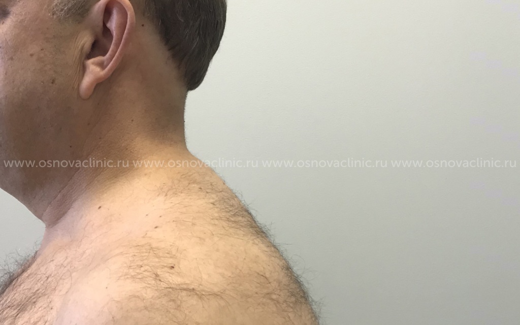 Доктор Тимошенко Александр Владимирович. Липосакция спины у мужчины. Фото после операции. Вид сбоку