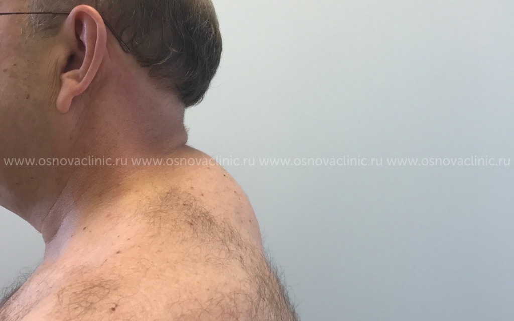 Доктор Тимошенко Александр Владимирович. Липосакция спины у мужчины. Фото до операции. Вид сбоку