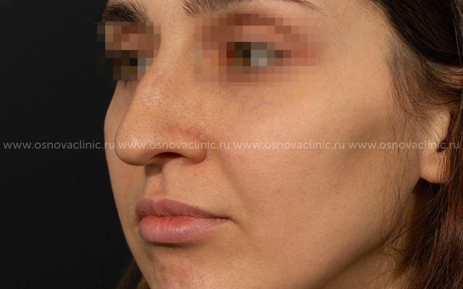 Как проходит операция по исправлению перегородки носа?