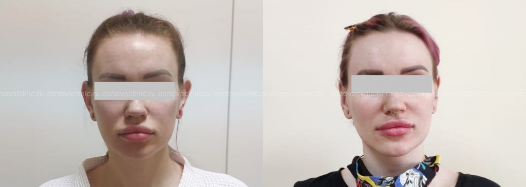 Назоев Кирилл Клиника Основа Пластика мочки уха после ношения тунелей