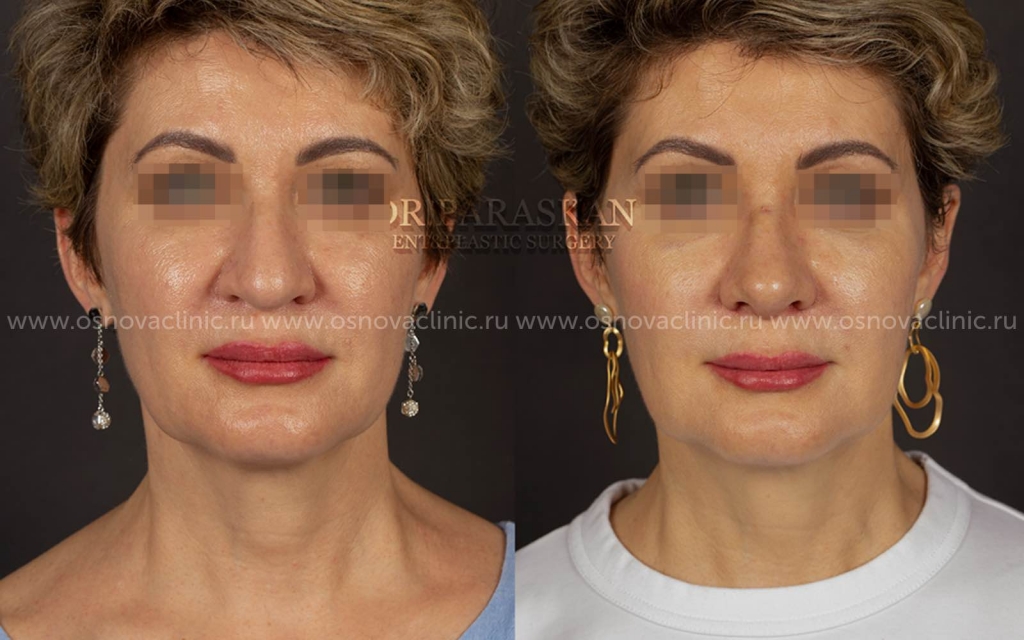 Послеоперационный уход после подтяжки лица - Beauty Space Clinic